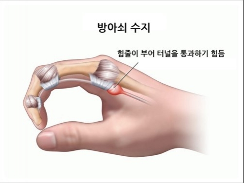 방아쇠수지